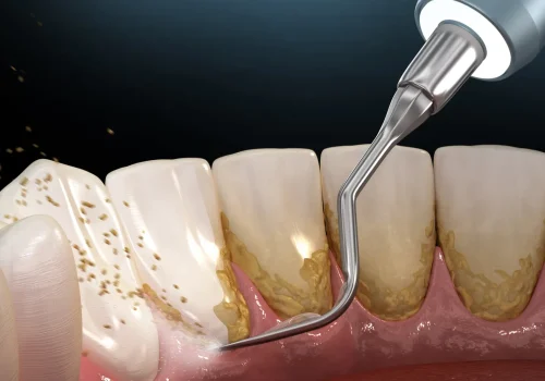 Does scaling really damage tooth enamel