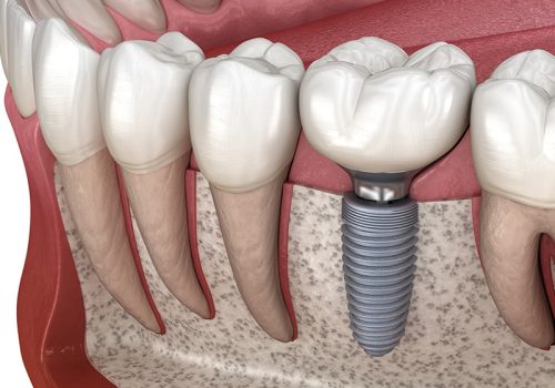 tooth-implant-steps